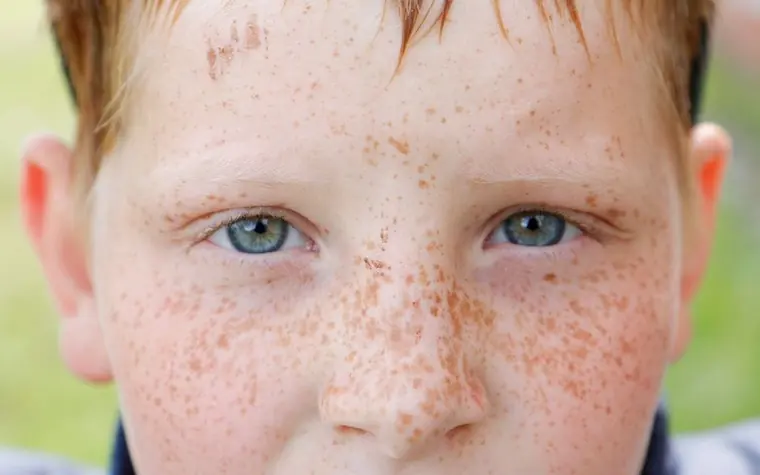 Close-up of a boy's face with freckles across the nose and cheeks